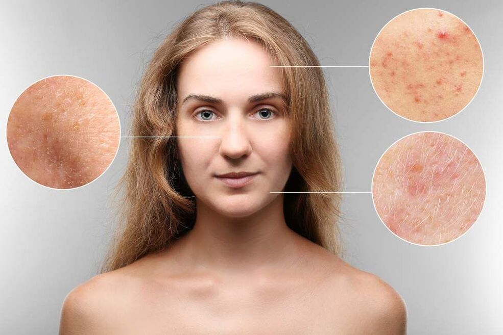 Hautausschläge im Gesicht mit Parasiten